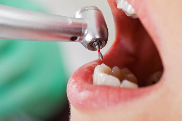 Best Broken or Cracked Tooth Emergency Dentist in Roselawn, IN